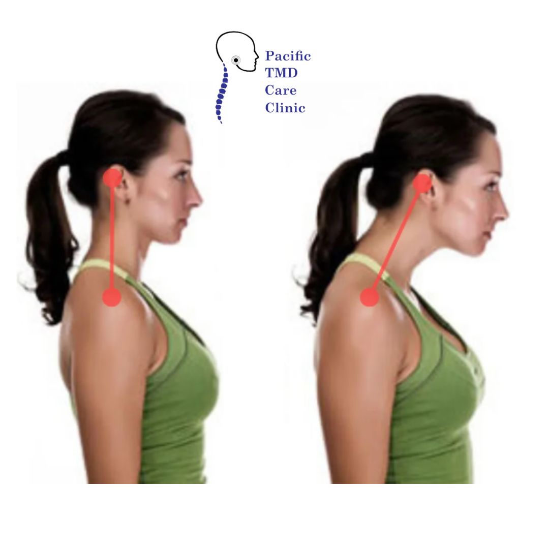 Featured image for “Understanding the Connection of TMD, Posture, and Headaches”